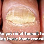 Get rid of toenail fungus - Simple home remedies