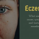 Eczema: Causes, symptoms and natural remedies 